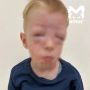 Малыш едва не умер после обеда в детском саду Хабаровска